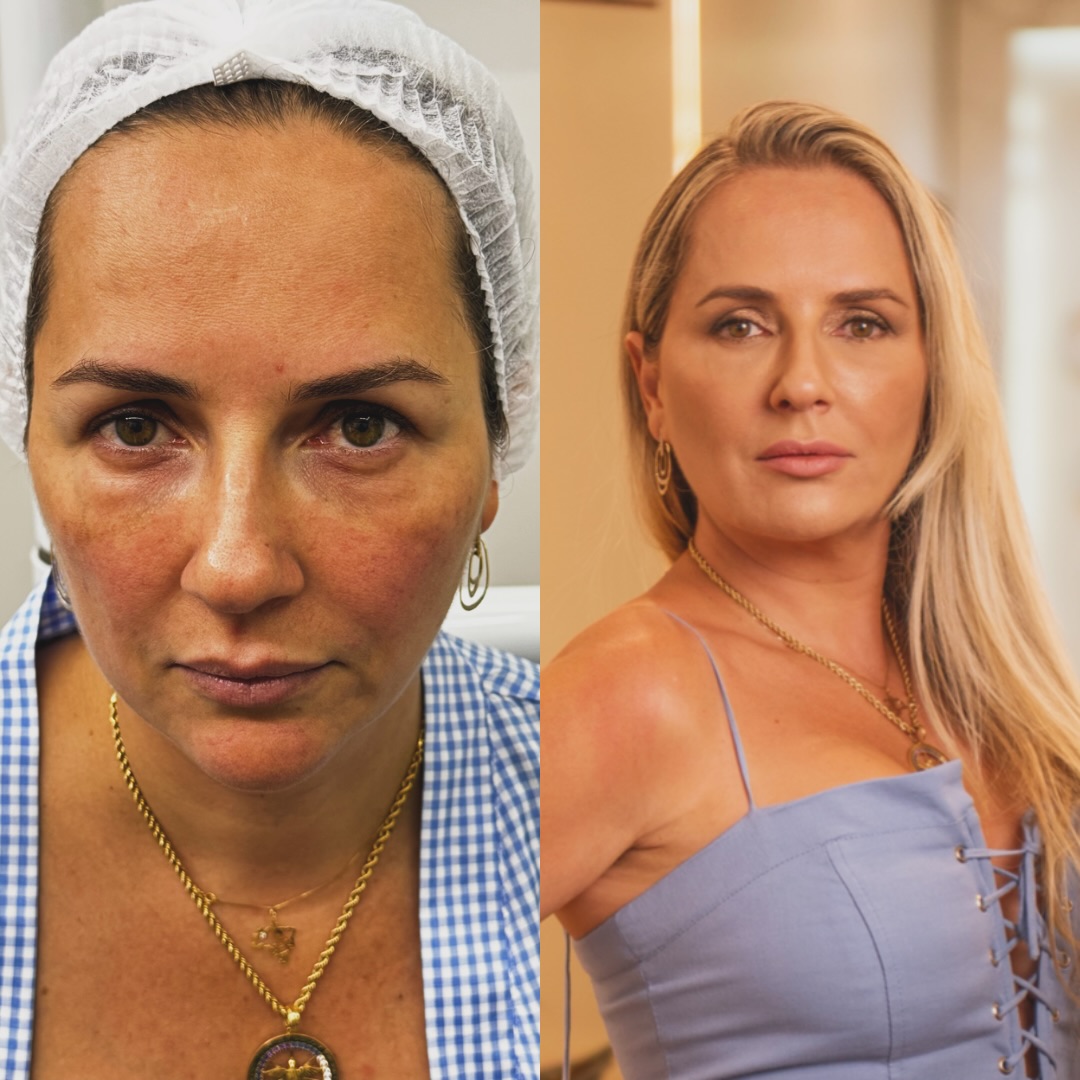 Registro de resultado facial publicado por Camila Subtil