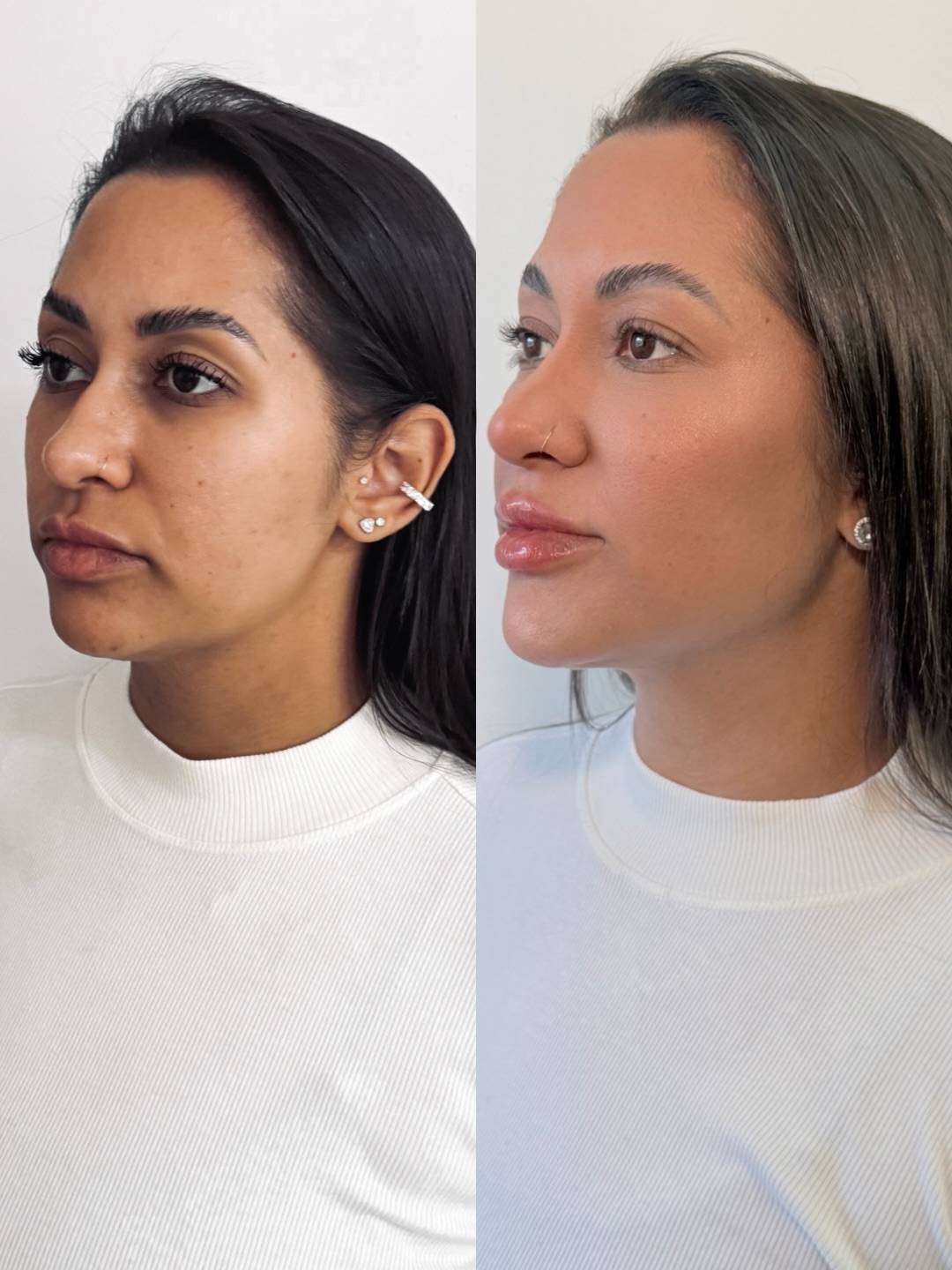 Comparativo de perfil facial publicado por Camila Subtil