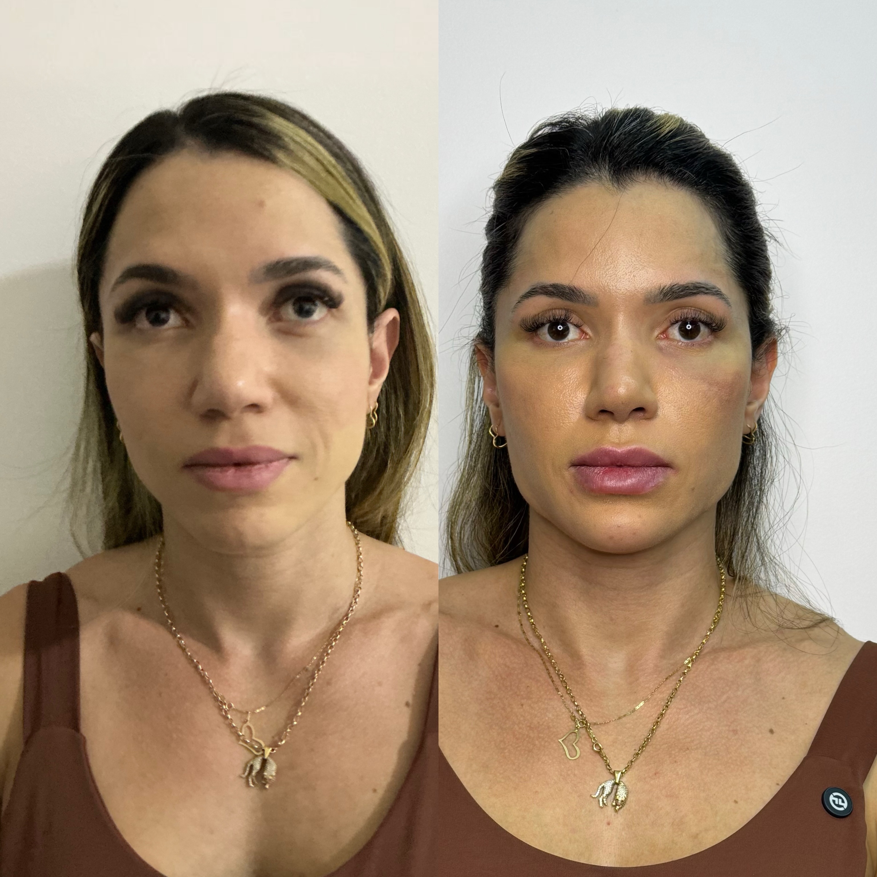 Resultado de harmonização facial publicado por Camila Subtil