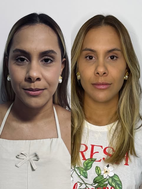 Evolução facial publicada por Camila Subtil