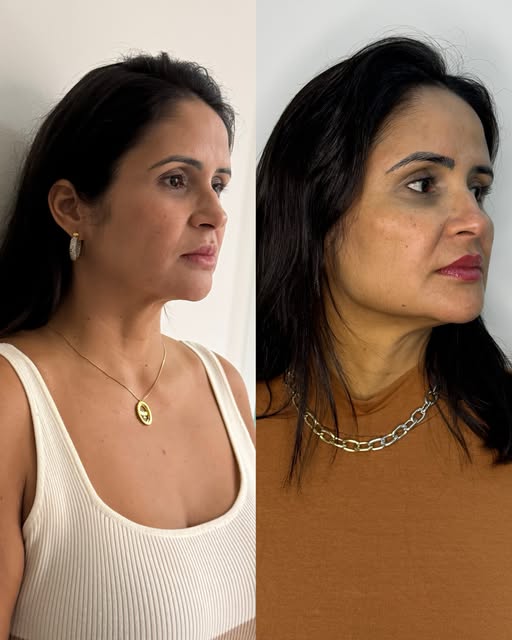 Registro de resultado de tratamento facial publicado por Camila Subtil