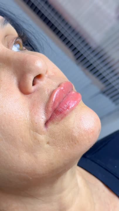 Resultado de preenchimento labial realizado pela Camila